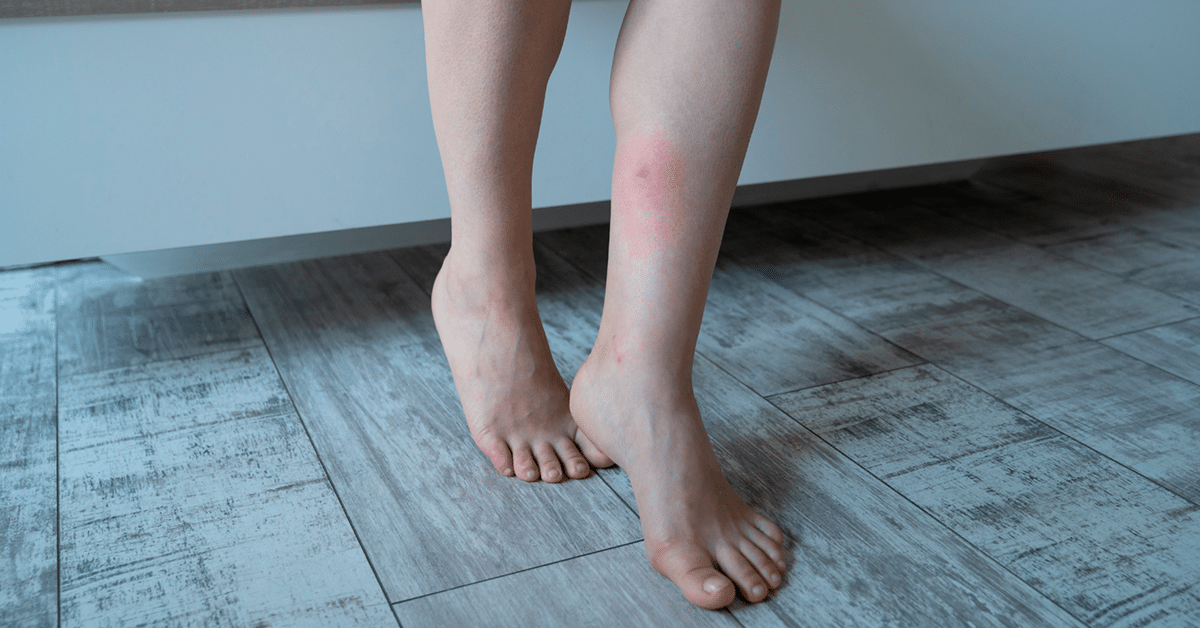 imagem de mulher picada por percevejos